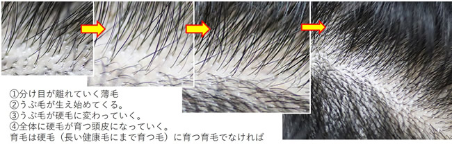 分け目の薄毛の改善例