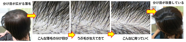 分け目の薄毛の改善例2